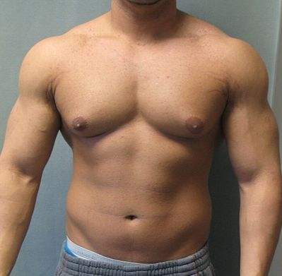 Gynecomastia years after steroids