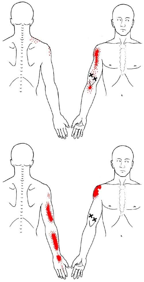 biceps brachii trigger points