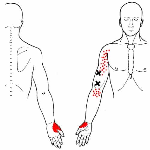 brachialis trigger points