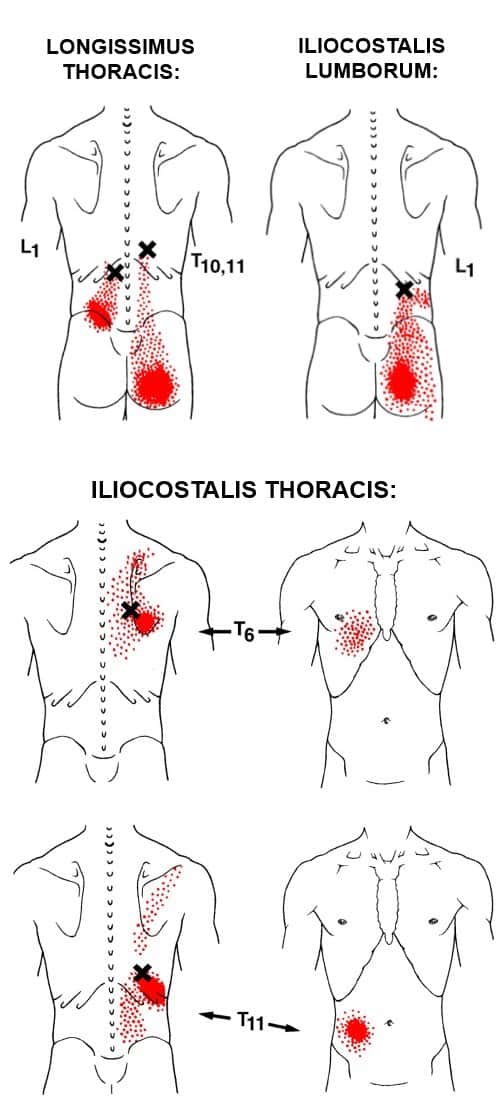 erector-spinae-trp