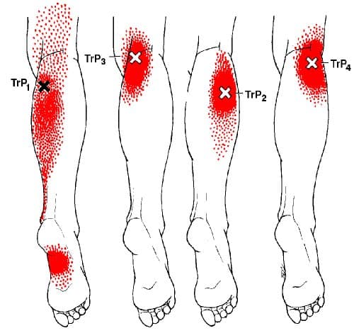 gastrocnemius trigger point