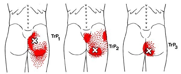 gluteus maximus trigger point