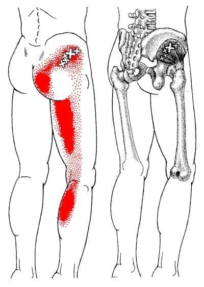 gluteus medius trigger points