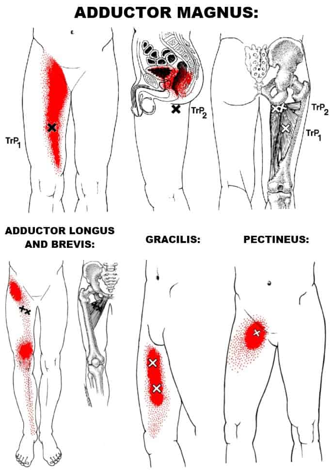 hip adductor trigger points