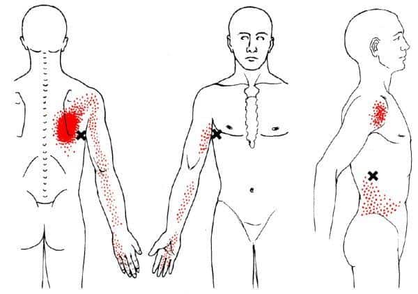 latissimus dorsi trigger points