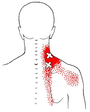 levator-scapulae-trp