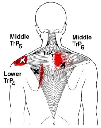 middle trapezius trigger points