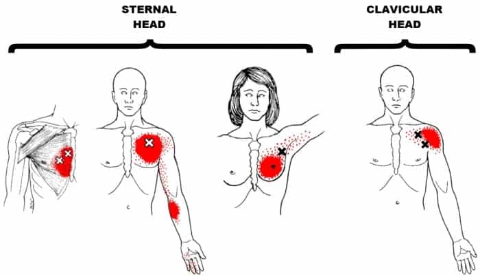 pectoralis major trigger points