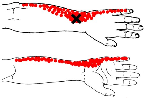 pronator quadratus trigger point