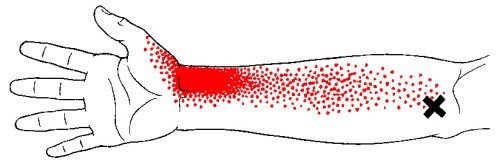 pronator teres trigger point