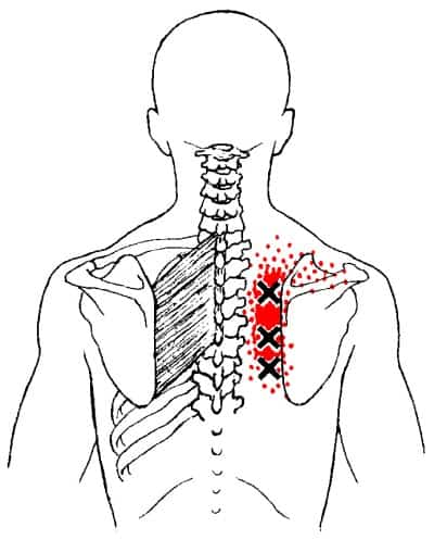 rhomboids trigger points