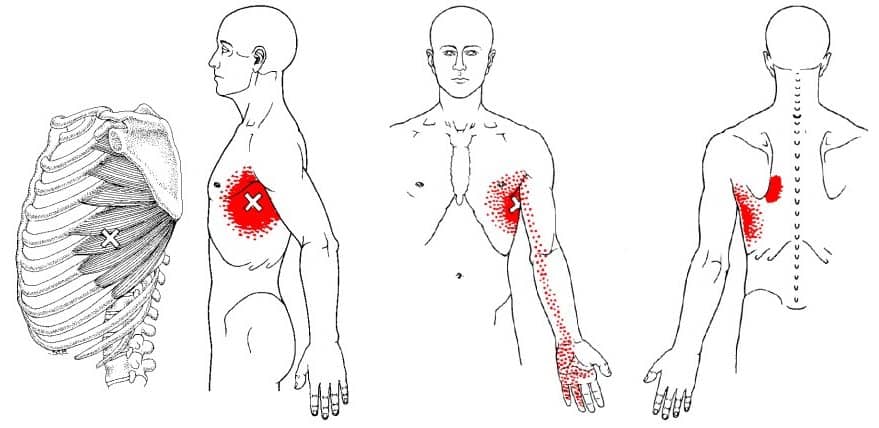 Serratus anterior trigger point