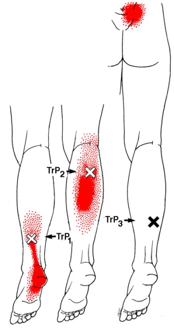 soleus trigger points