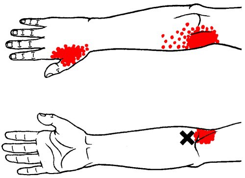 supinator trigger point