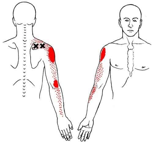 Supraspinatus trigger point