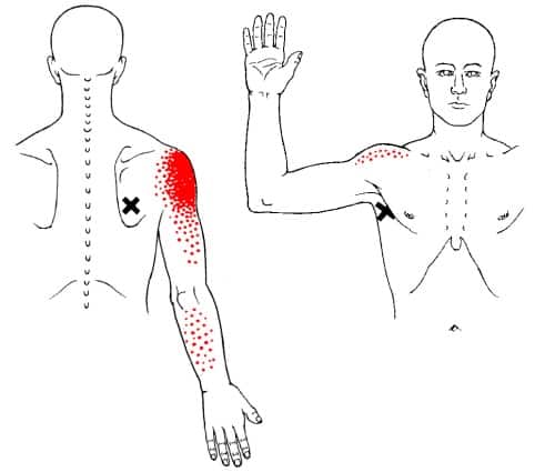 Teres major trigger point