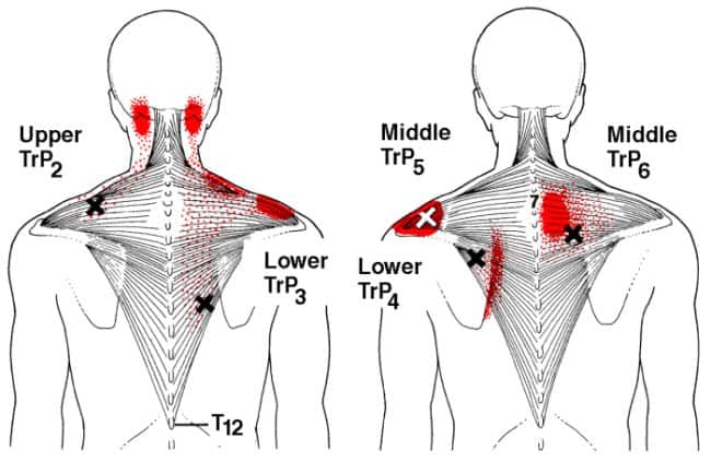 Trapezius trigger points