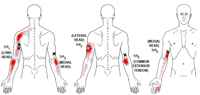 triceps brachii trigger points