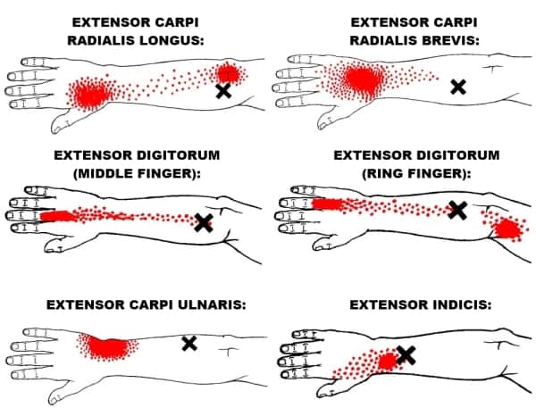 wrist extensor trigger points