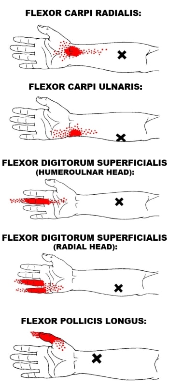 wrist flexor trigger points